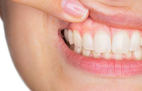 7 Tips to Prevent Gum Disease